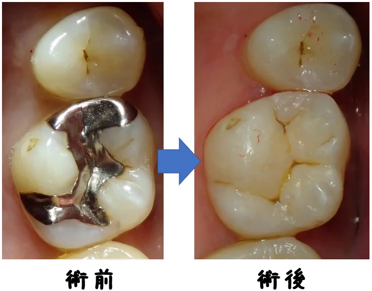 ダイレクトボンディング⑨｜坂寄歯科医院（取手市藤代） - 画像5