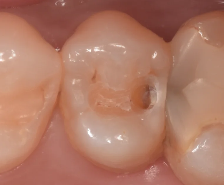 開業歯科医師の方を治療。|坂寄歯科医院(取手市藤代) - 画像2