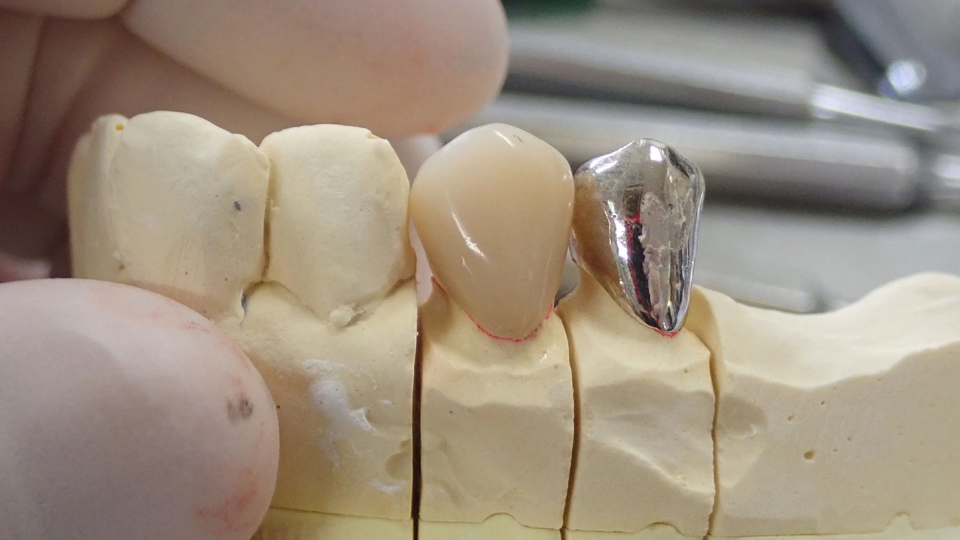 硬質レジンジャケット冠｜坂寄歯科医院（取手市藤代） - 画像4