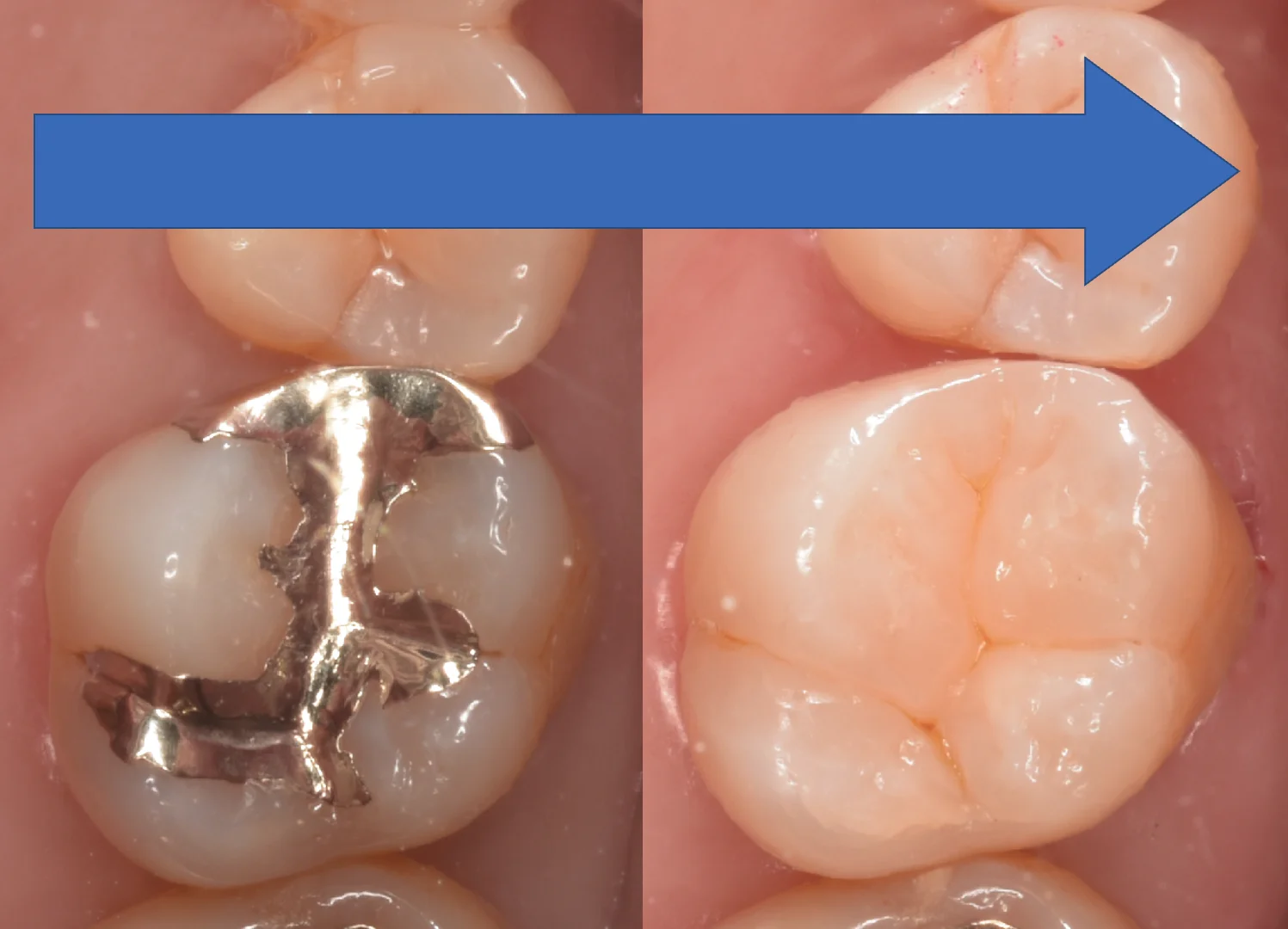 金属の詰め物を白い歯に。｜坂寄歯科医院（取手市藤代） - 画像5