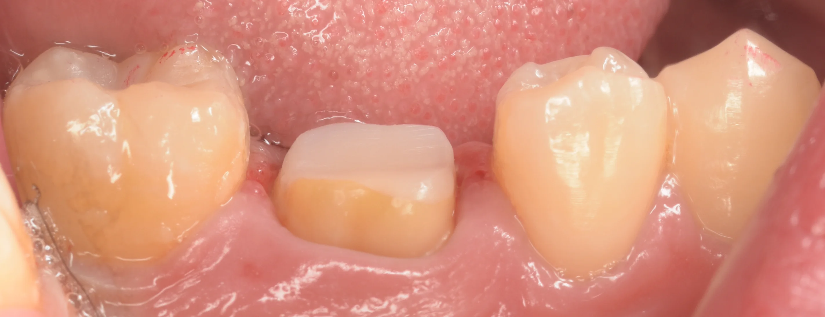 セラミックの被せ物｜坂寄歯科医院（取手市藤代） - 画像4