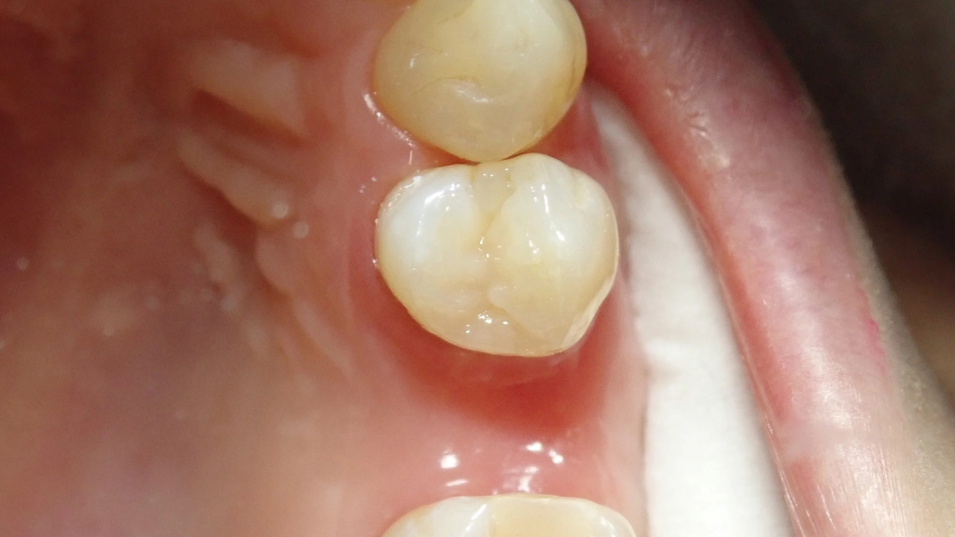 ダイレクトボンディング④｜坂寄歯科医院（取手市藤代） - 画像7