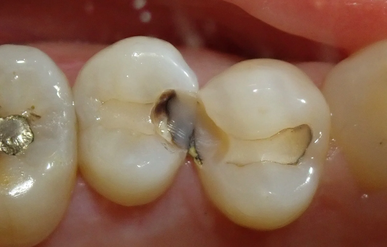 保険の白い詰め物｜坂寄歯科医院（取手市藤代） - 画像2