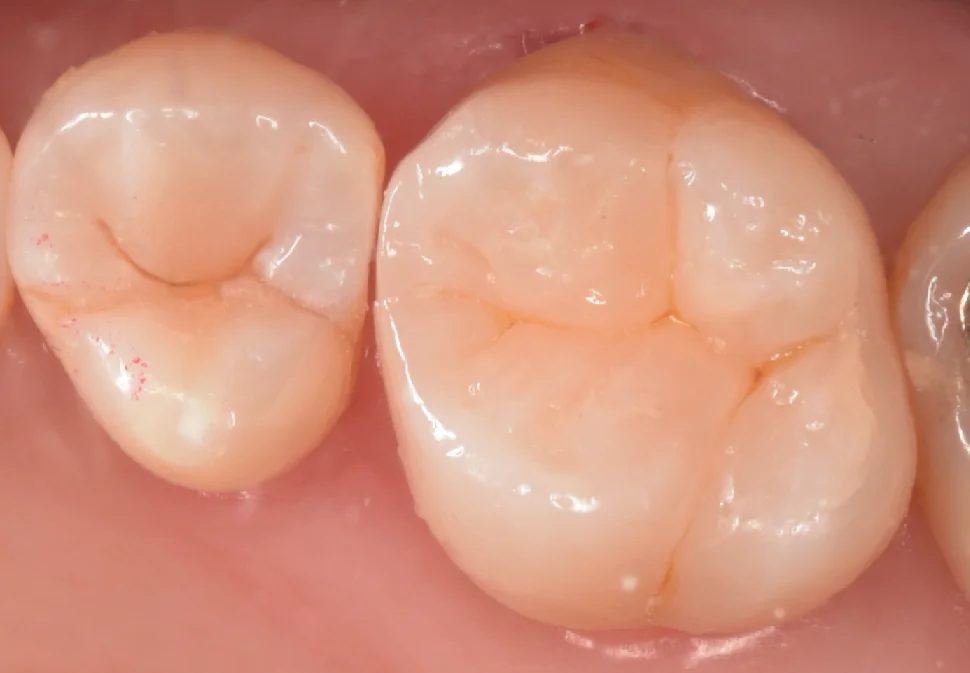 金属の詰め物を白い歯に。｜坂寄歯科医院（取手市藤代） - 画像4