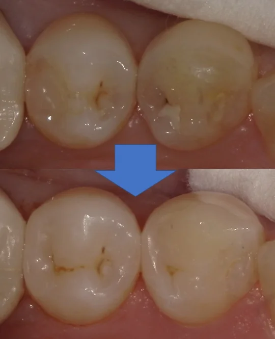 右下奥歯を纏めて治療。遠方からの通院。|坂寄歯科医院(取手市藤代) - 画像5