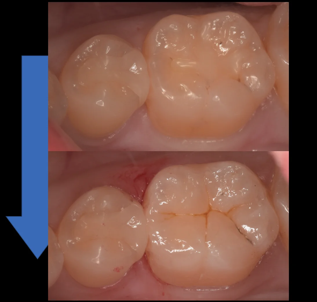 歯科医師の歯を1日で本物の歯のように。｜坂寄歯科医院（取手市藤代） - 画像4