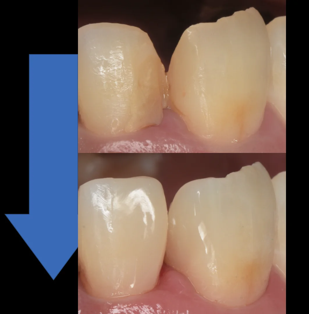 不適合なレジンを再治療。｜坂寄歯科医院（取手市藤代） - 画像4