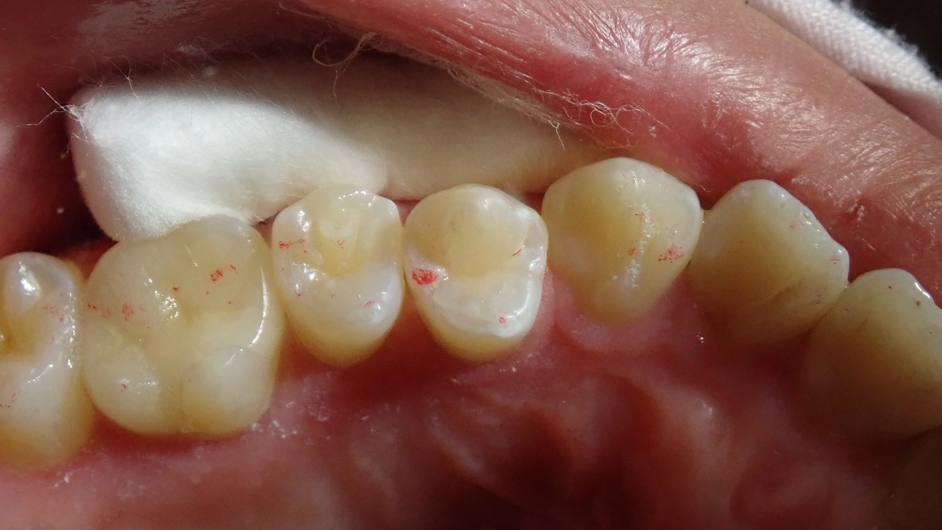 中心結節破折が原因で起こった神経の壊死を放置して、外部吸収が起こったケース|坂寄歯科医院(取手市藤代) - 画像4