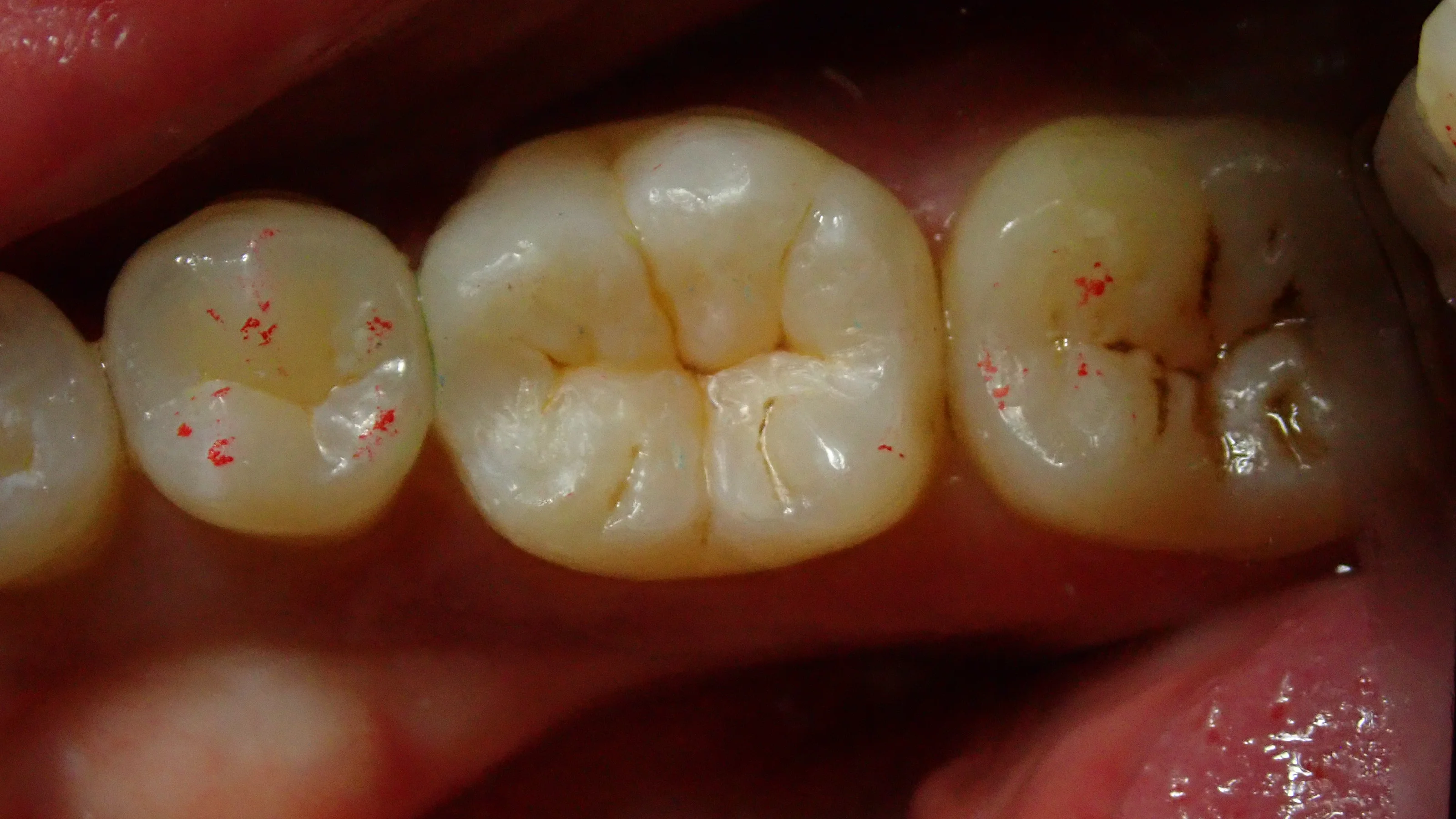 ダイレクトボンディング⑧｜坂寄歯科医院（取手市藤代） - 画像5