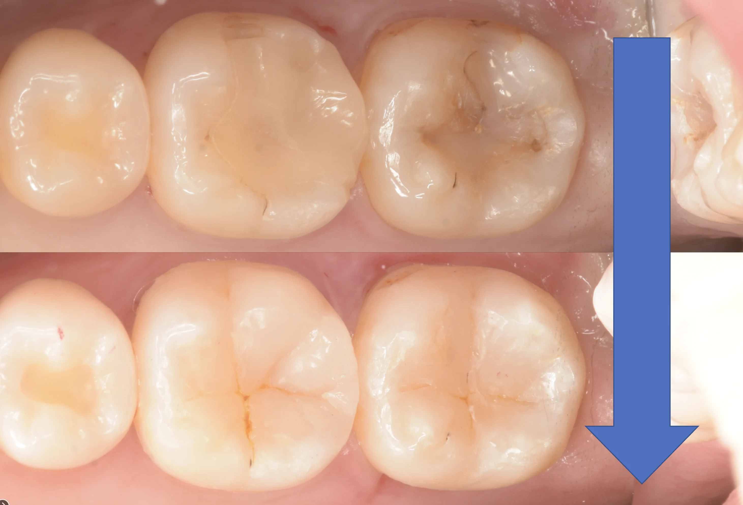 歯科医師の方のCAD/CAMインレーを治療。|坂寄歯科医院(取手市藤代) - 画像9