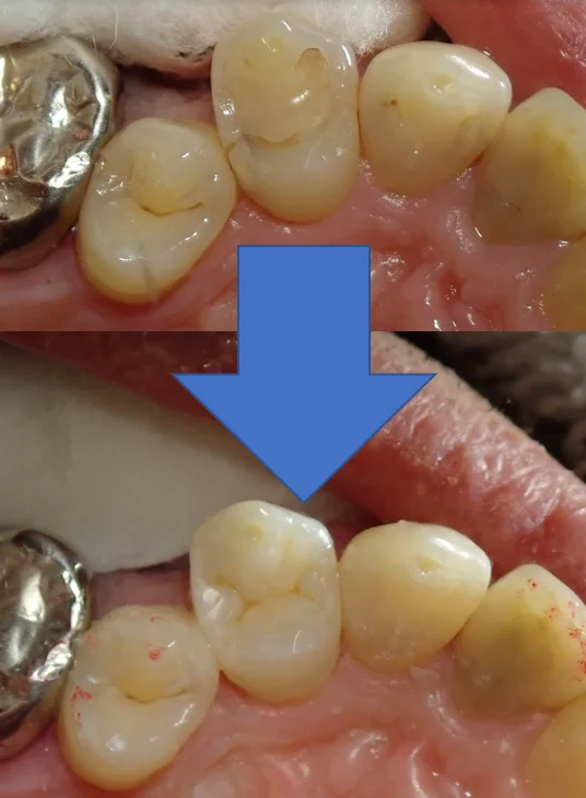 左上3本まとめてダイレクトボンディング｜坂寄歯科医院（取手市藤代） - 画像4