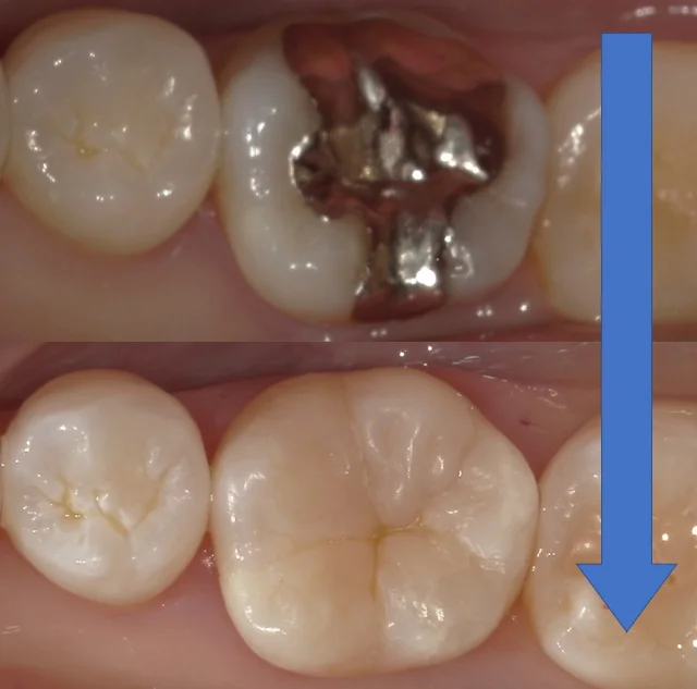 他院勤務中の歯科衛生士さんの治療を行いました。|坂寄歯科医院(取手市藤代) - 画像4