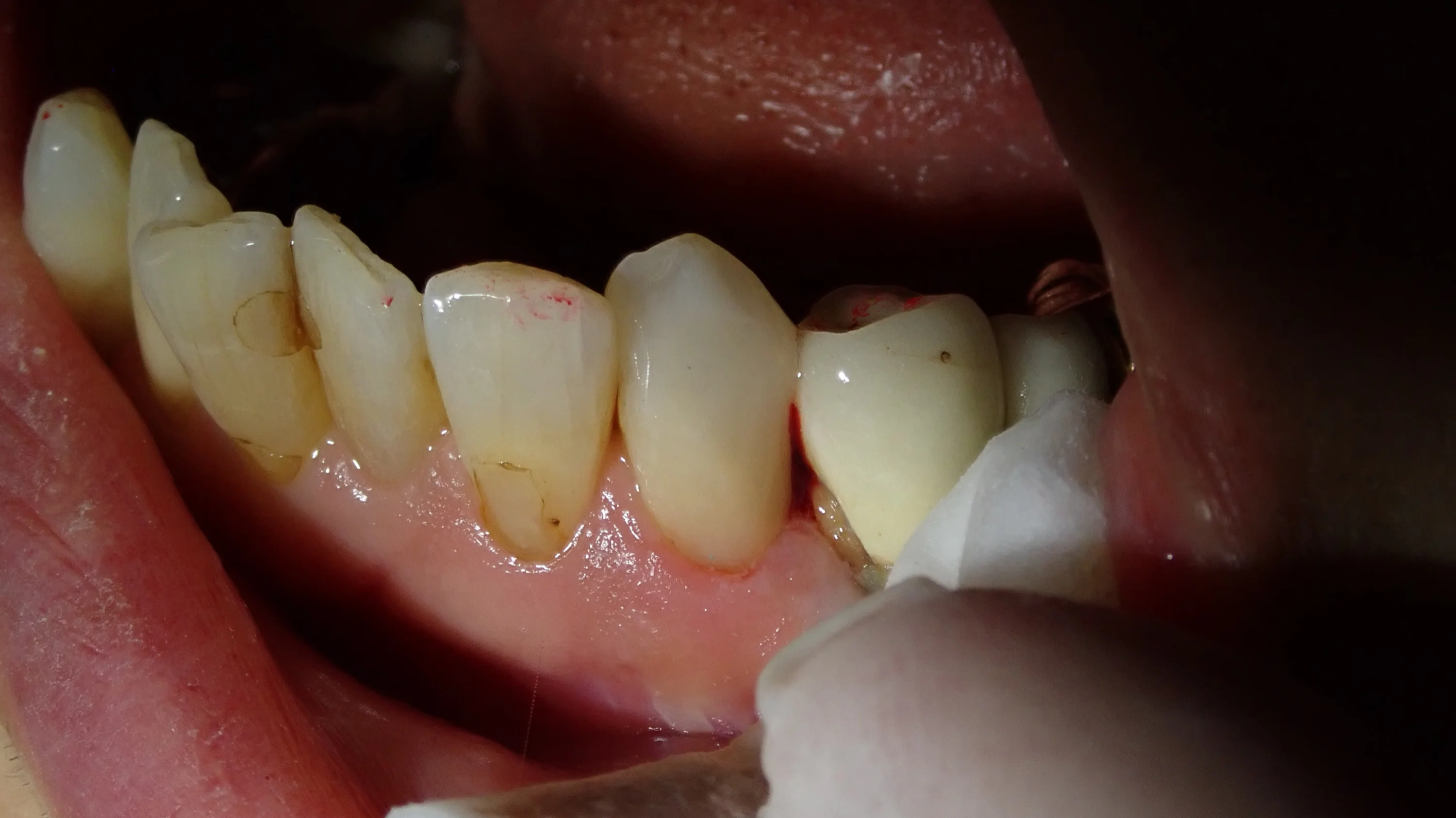 下顎前歯ダイレクトボンディング|坂寄歯科医院(取手市藤代) - 画像3