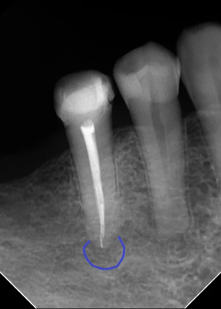 レジンでは無理ですって!|坂寄歯科医院(取手市藤代) - 画像2