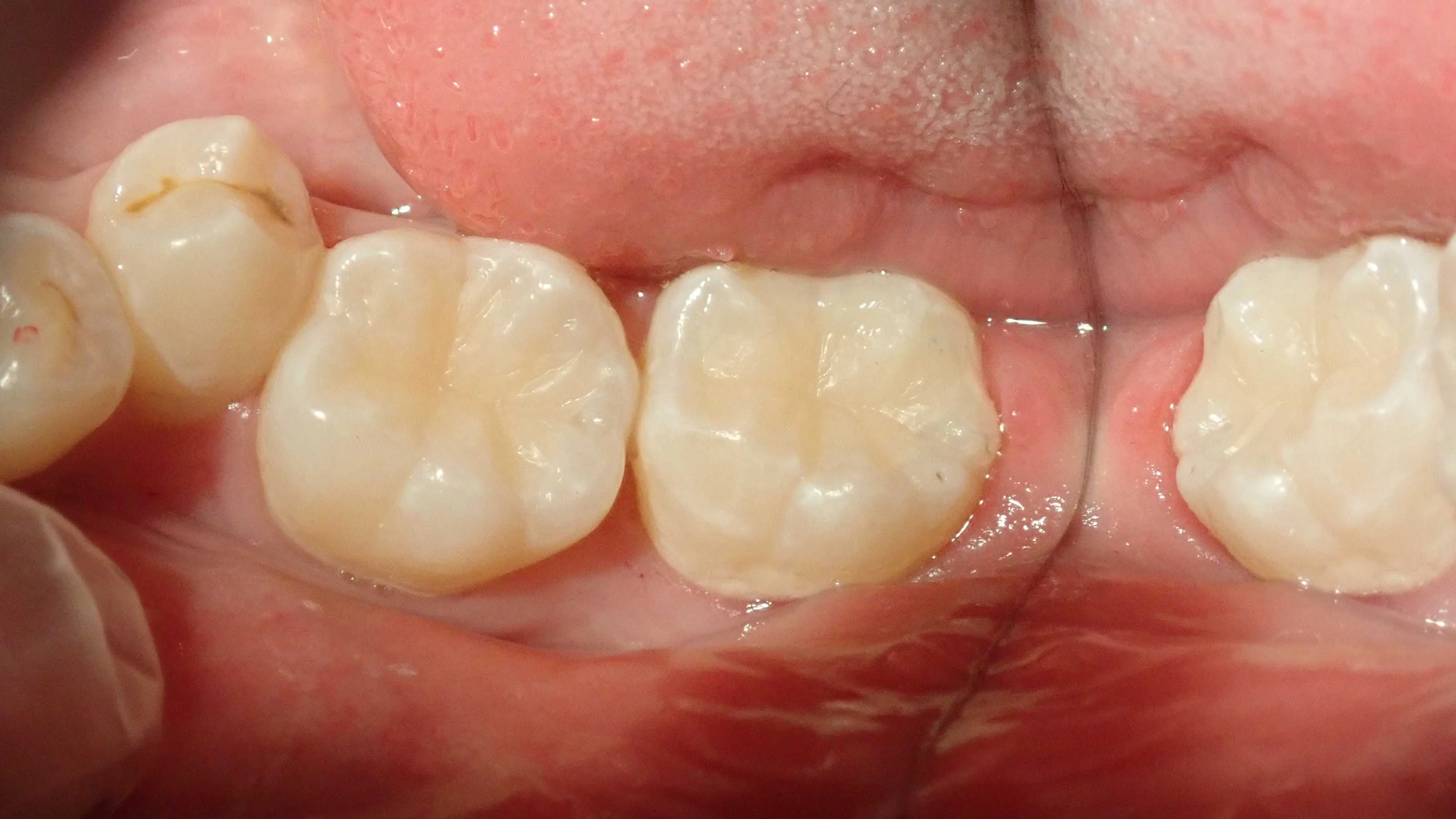 コンポジットレジン修復|坂寄歯科医院(取手市藤代) - 画像3