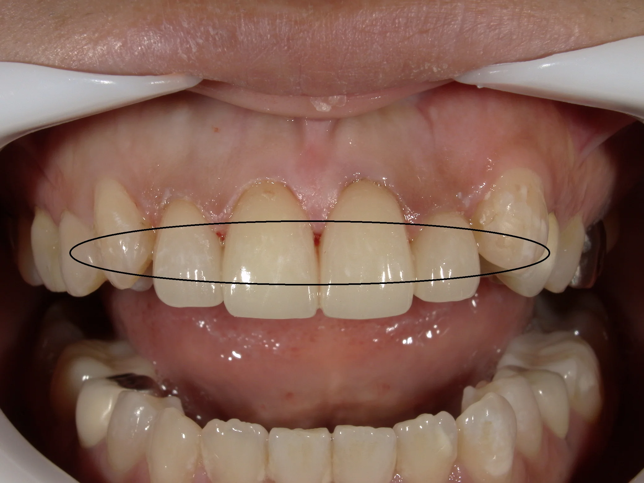 前歯セラミッククラウン｜坂寄歯科医院（取手市藤代） - 画像2