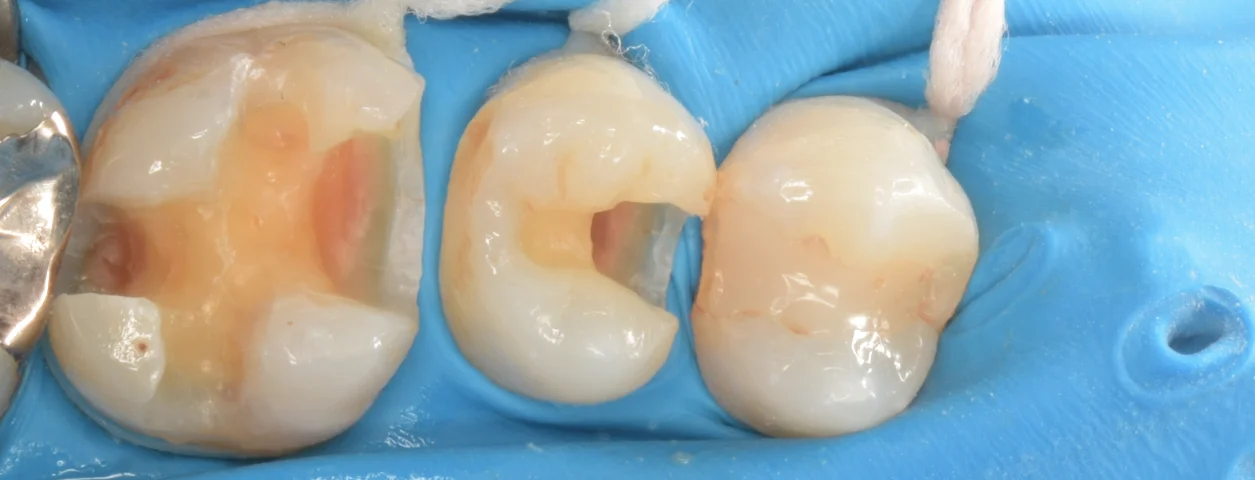 歯科医師の方を治療。|坂寄歯科医院(取手市藤代) - 画像3