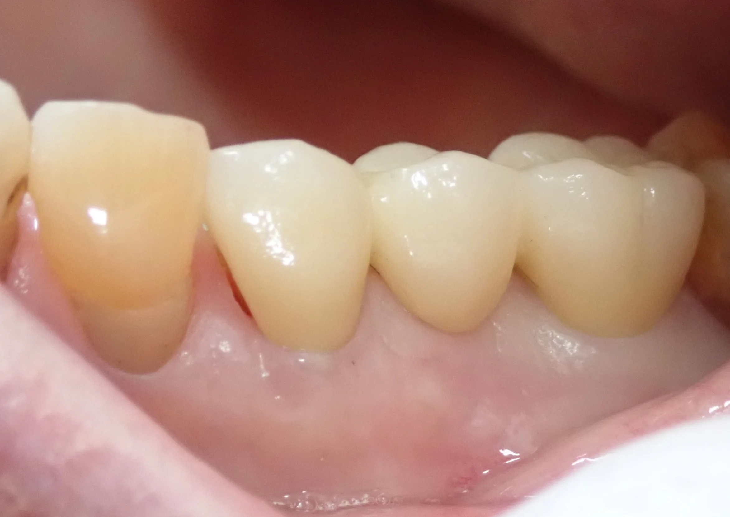 仮歯へのこだわり｜坂寄歯科医院（取手市藤代） - 画像3