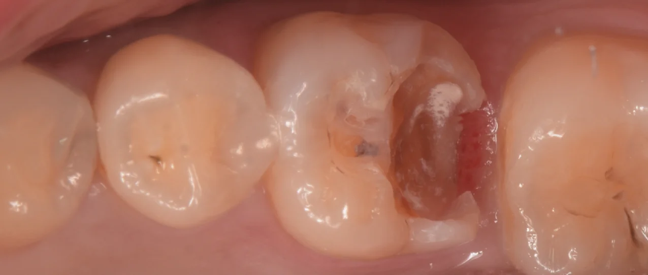 歯科医師の方のCAD/CAMインレーを治療。|坂寄歯科医院(取手市藤代) - 画像2