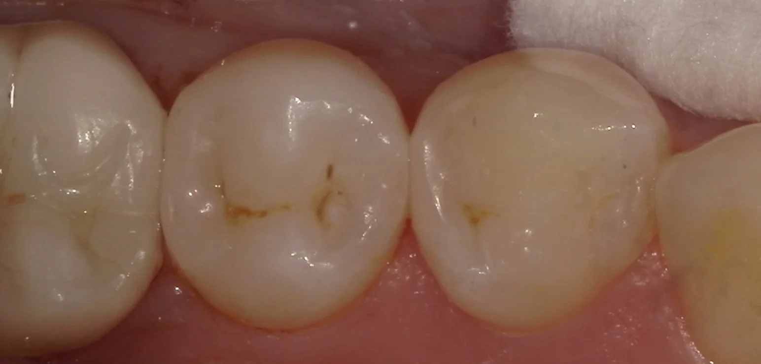 右下奥歯を纏めて治療。遠方からの通院。|坂寄歯科医院(取手市藤代) - 画像4