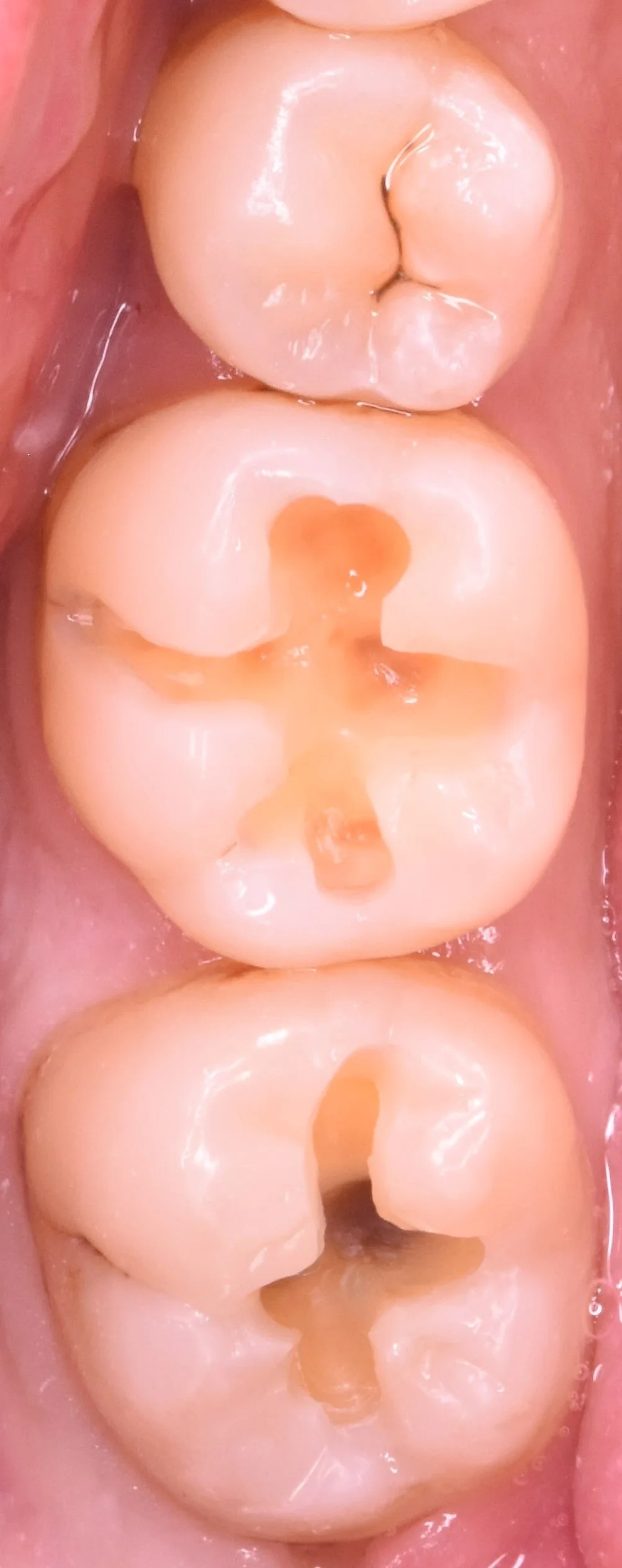 奥歯2本の治療を1日で。｜坂寄歯科医院（取手市藤代） - 画像3