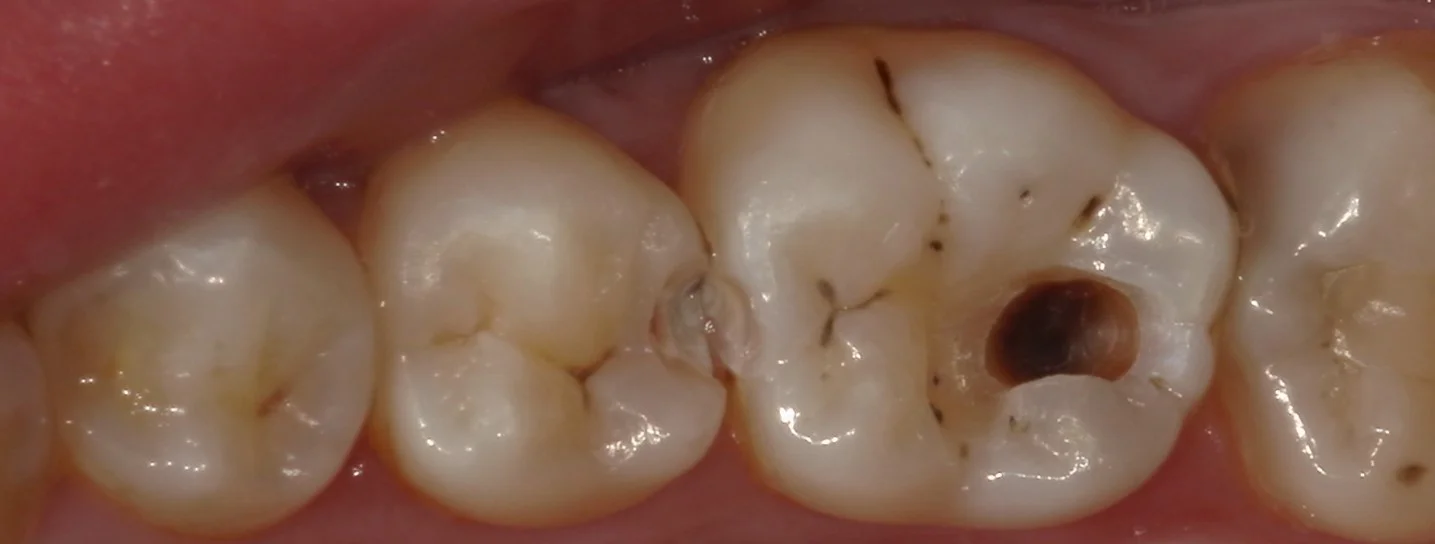 歯科医師の方をダイレクトボンディングにて治療。｜坂寄歯科医院（取手市藤代） - 画像2