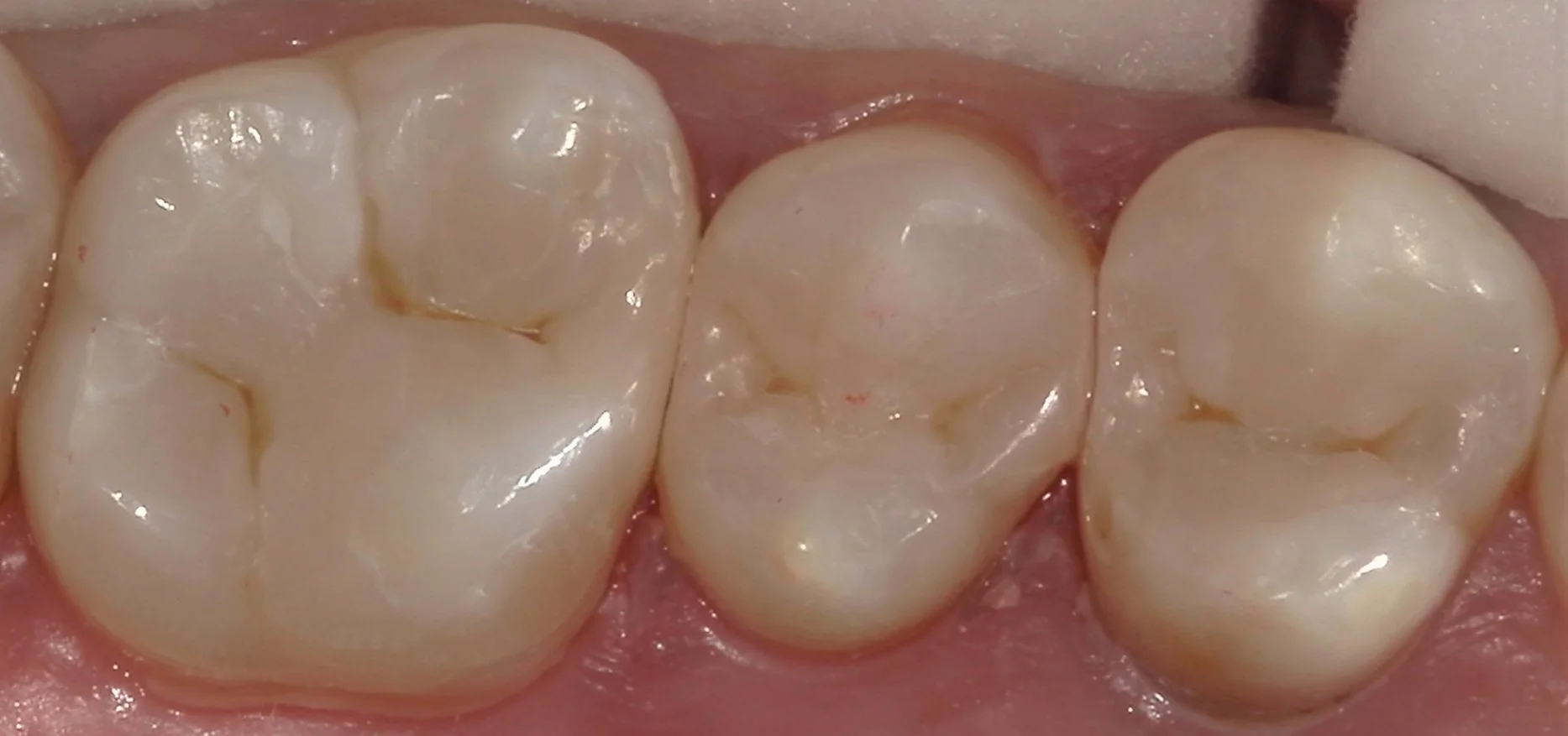 遠方から来院の方を白い詰め物にて治療。|坂寄歯科医院(取手市藤代) - 画像7