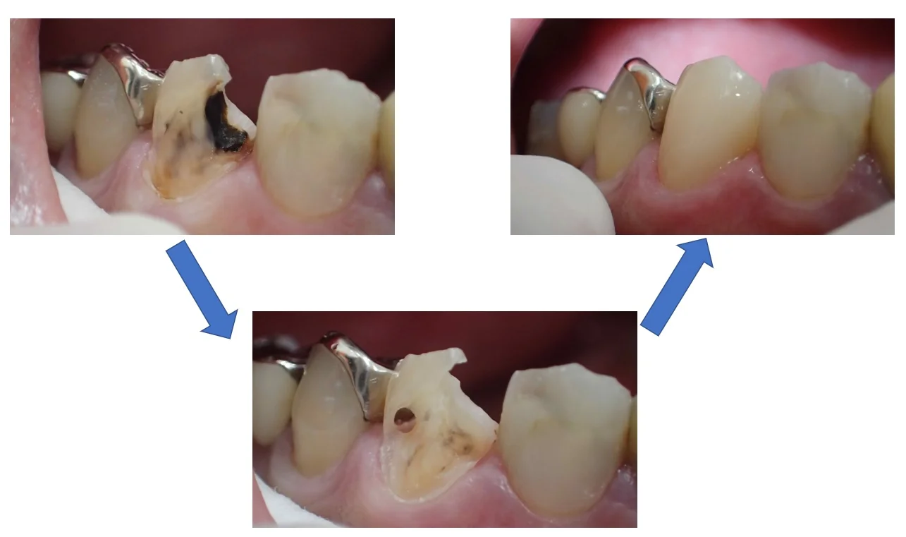 前歯のダイレクトボンディング|坂寄歯科医院(取手市藤代) - 画像2