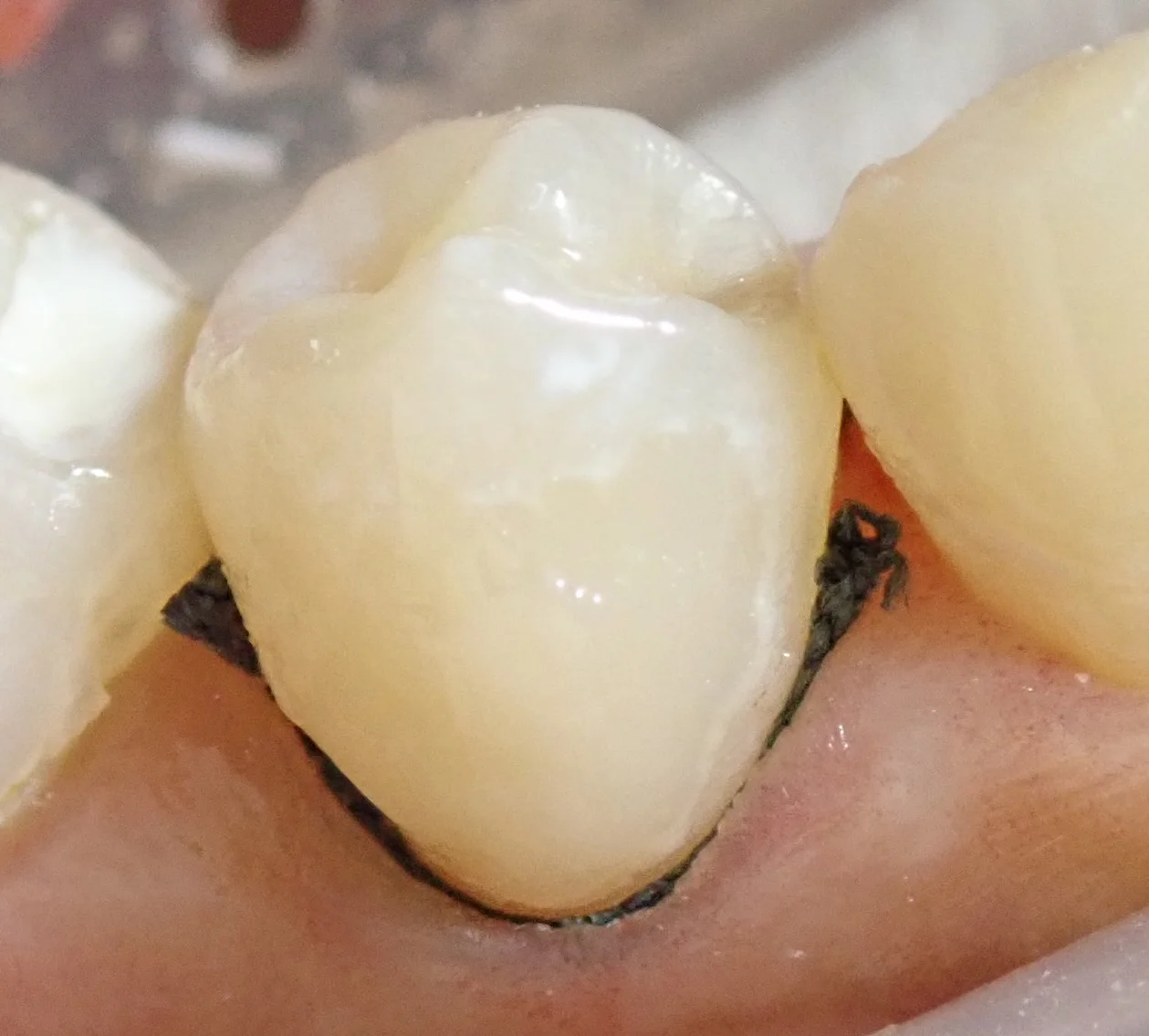 圧排糸を使ったレジン治療。｜坂寄歯科医院（取手市藤代） - 画像5