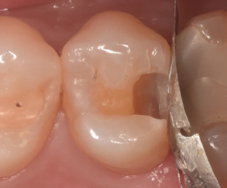 開業歯科医師の方を治療。|坂寄歯科医院(取手市藤代) - 画像3