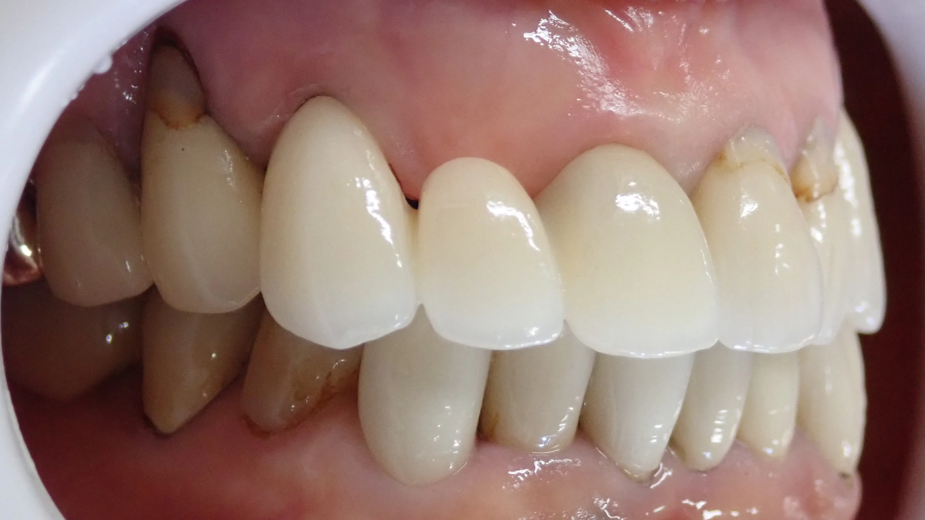 オールセラミックスブリッジ｜坂寄歯科医院（取手市藤代） - 画像3