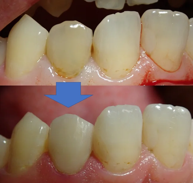 前歯のダイレクトベニア｜坂寄歯科医院（取手市藤代） - 画像5