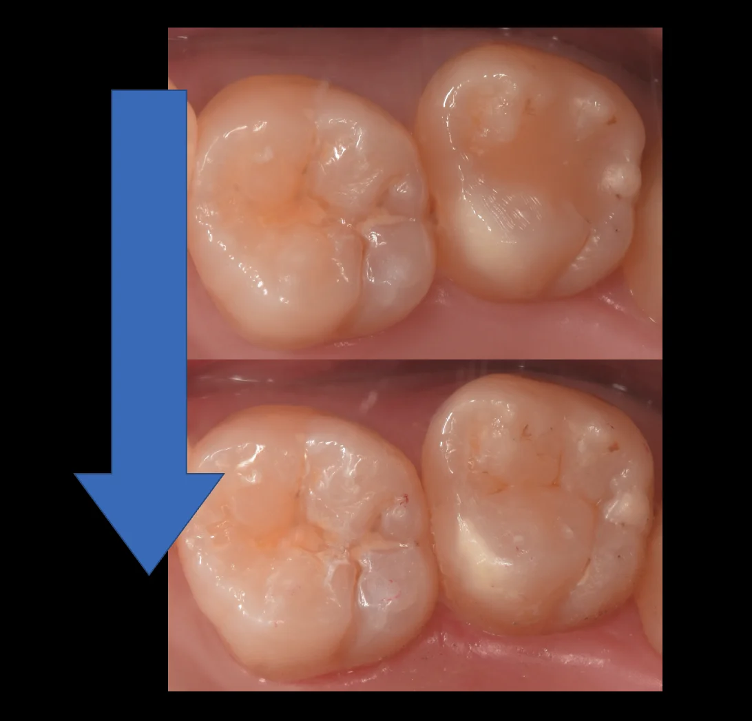 新しくできた虫歯と古い詰め物を同時に治療。|坂寄歯科医院(取手市藤代) - 画像5