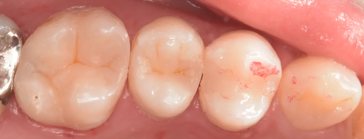 歯科医師の方を治療。|坂寄歯科医院(取手市藤代) - 画像4