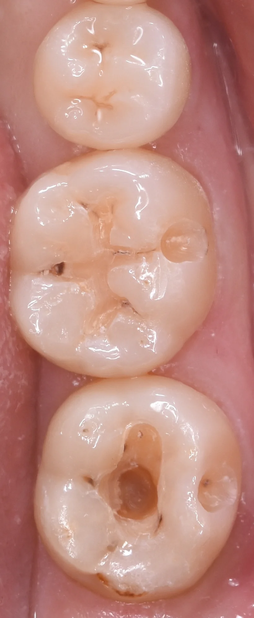 他県にて勤務中の歯科衛生士の方の治療。|坂寄歯科医院(取手市藤代) - 画像2