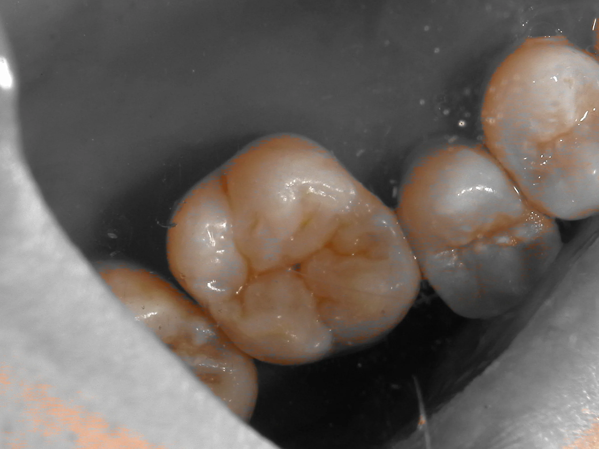 右上6ダイレクトボンディング｜坂寄歯科医院（取手市藤代） - 画像6