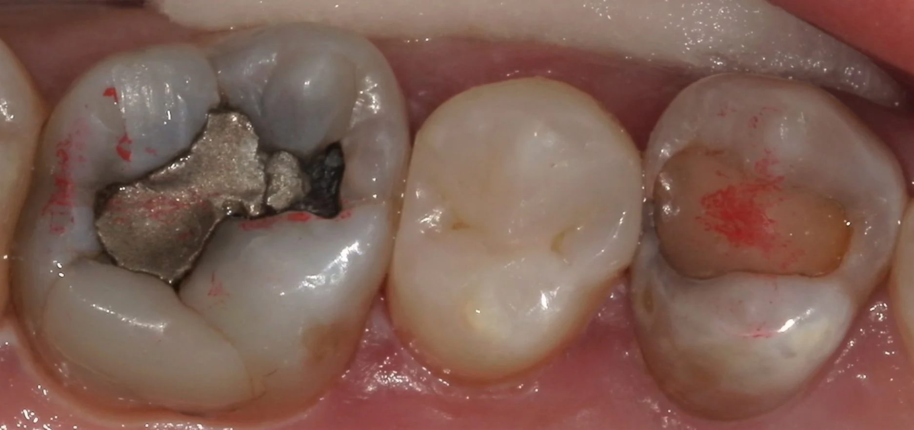 遠方から来院の方を白い詰め物にて治療。|坂寄歯科医院(取手市藤代) - 画像4