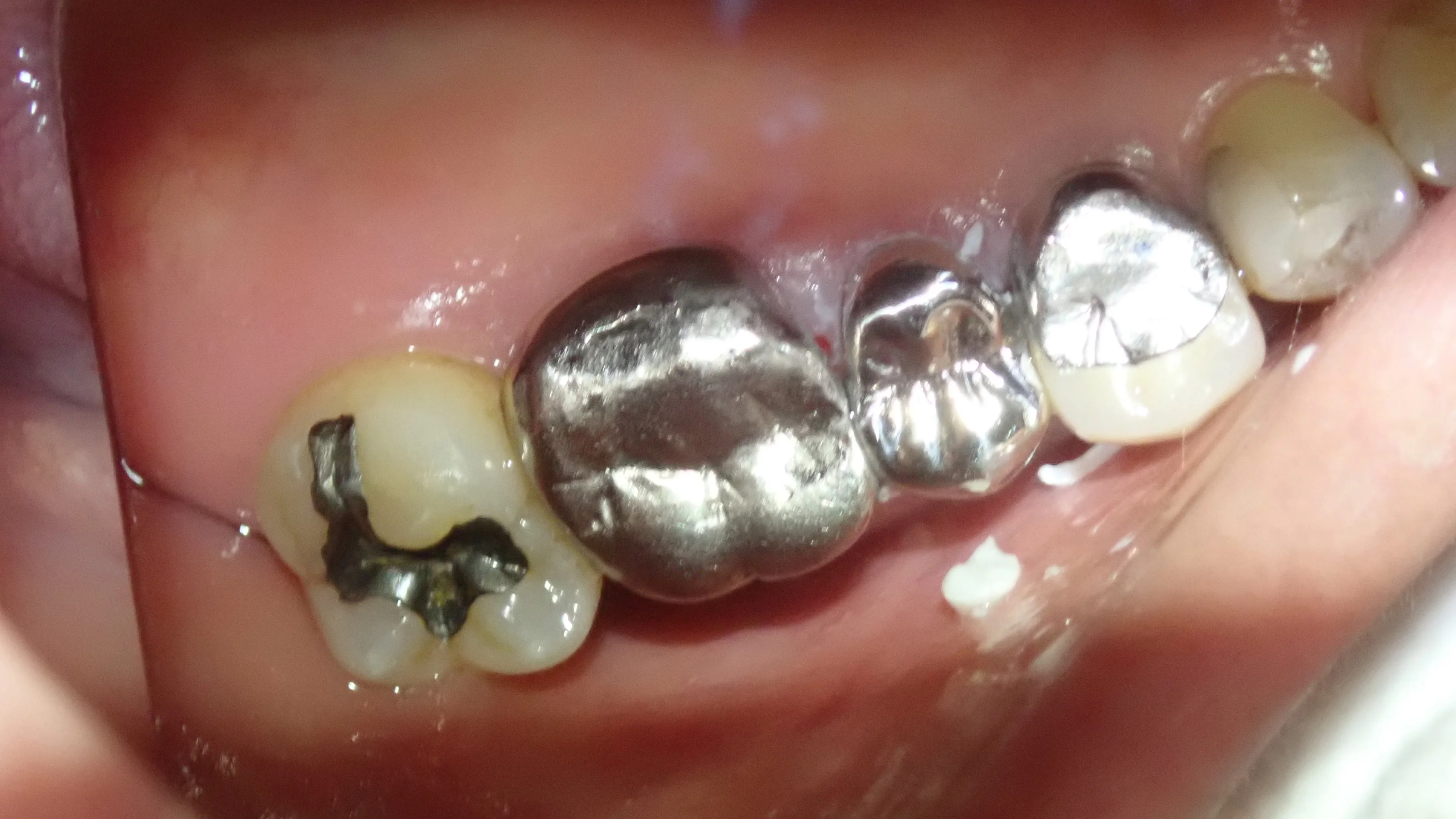 メタルクラウン|坂寄歯科医院(取手市藤代) - 画像7