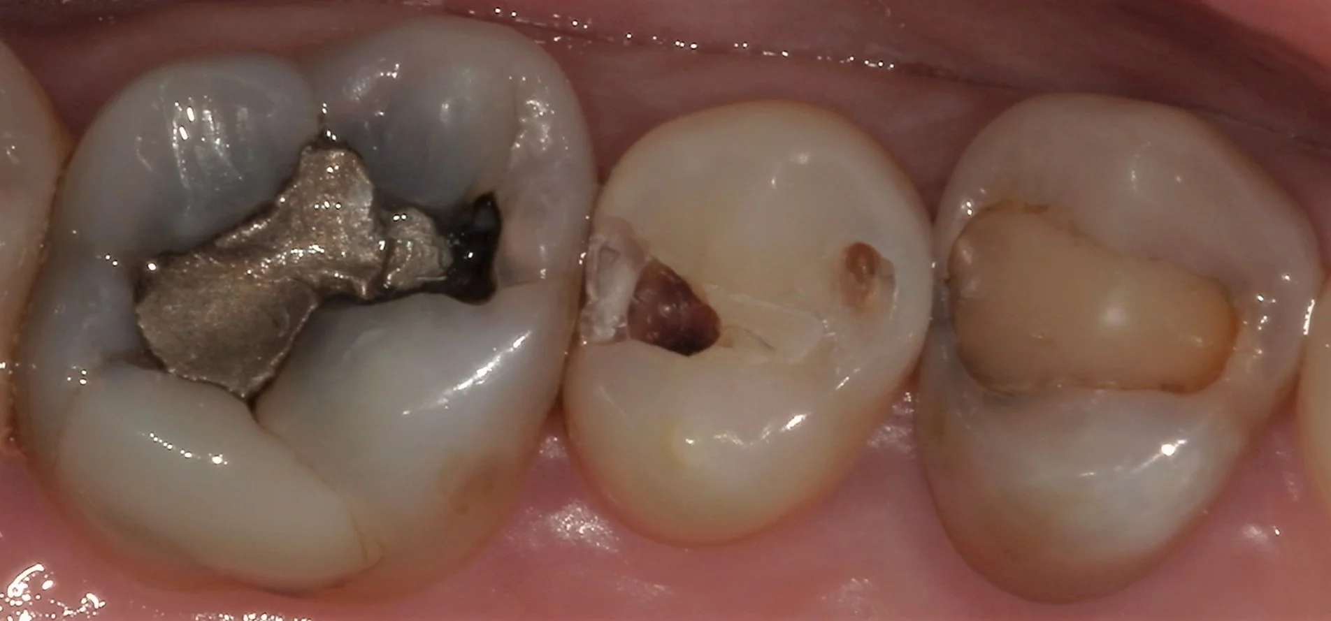 遠方から来院の方を白い詰め物にて治療。|坂寄歯科医院(取手市藤代) - 画像2