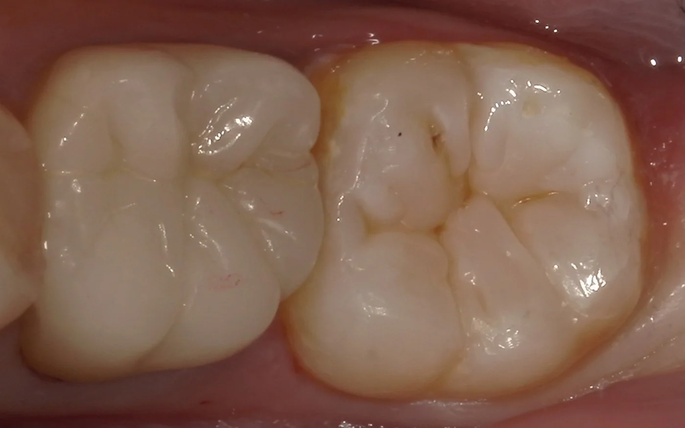 遠方より虫歯の治療で通院された方を一日で治療しました。|坂寄歯科医院(取手市藤代) - 画像4