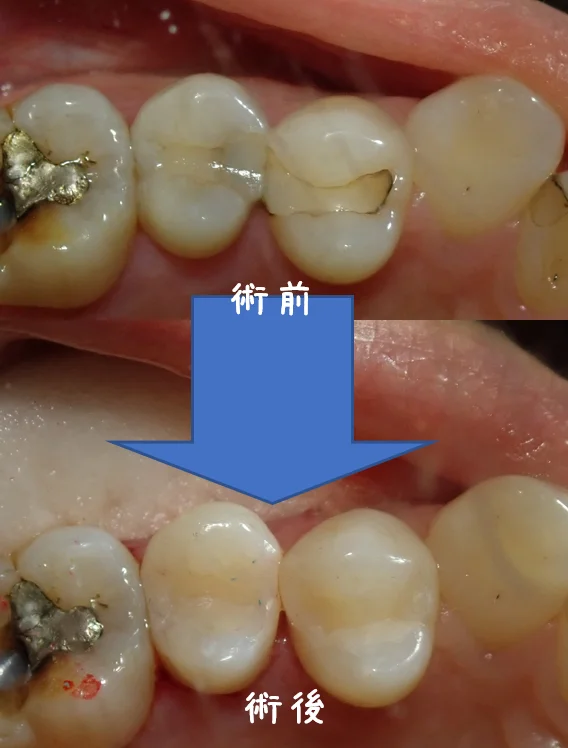 白い部分的な詰め物｜坂寄歯科医院（取手市藤代） - 画像6