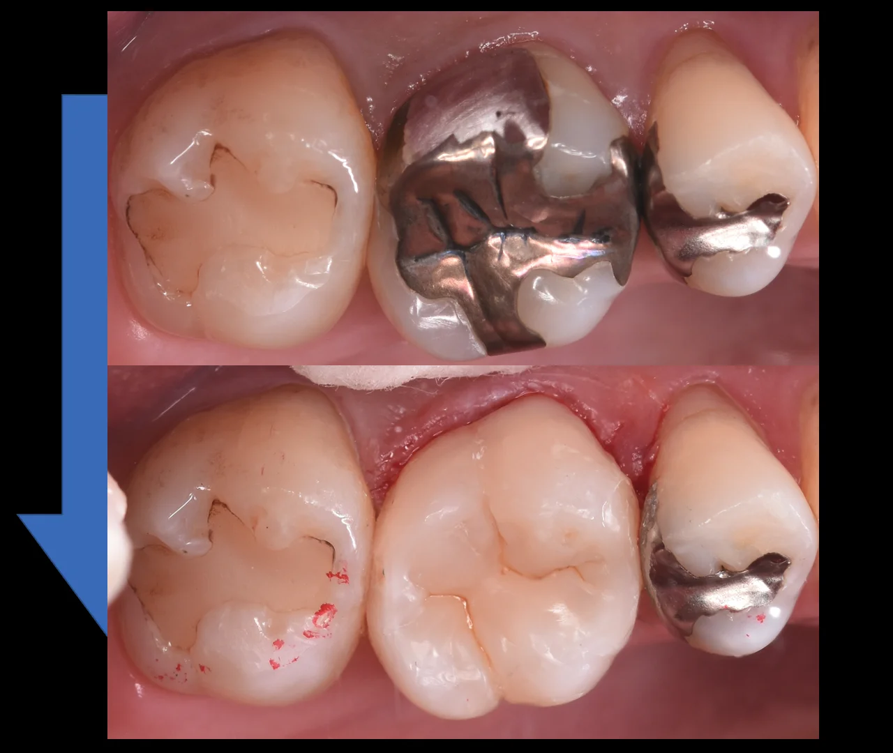 金属を白い詰め物に。|坂寄歯科医院(取手市藤代) - 画像4