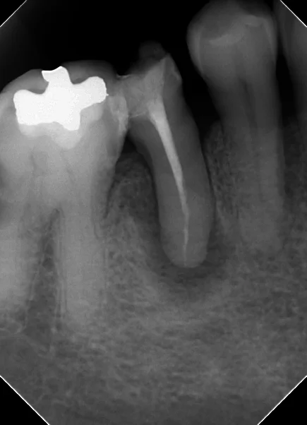 閉鎖根管の治療には根気が必要|坂寄歯科医院(取手市藤代) - 画像3