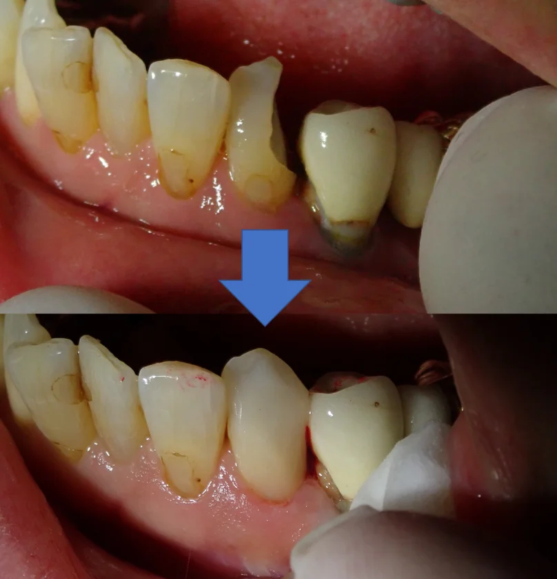 下顎前歯ダイレクトボンディング|坂寄歯科医院(取手市藤代) - 画像4