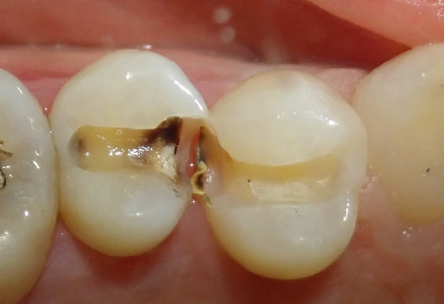 保険の白い詰め物｜坂寄歯科医院（取手市藤代） - 画像3