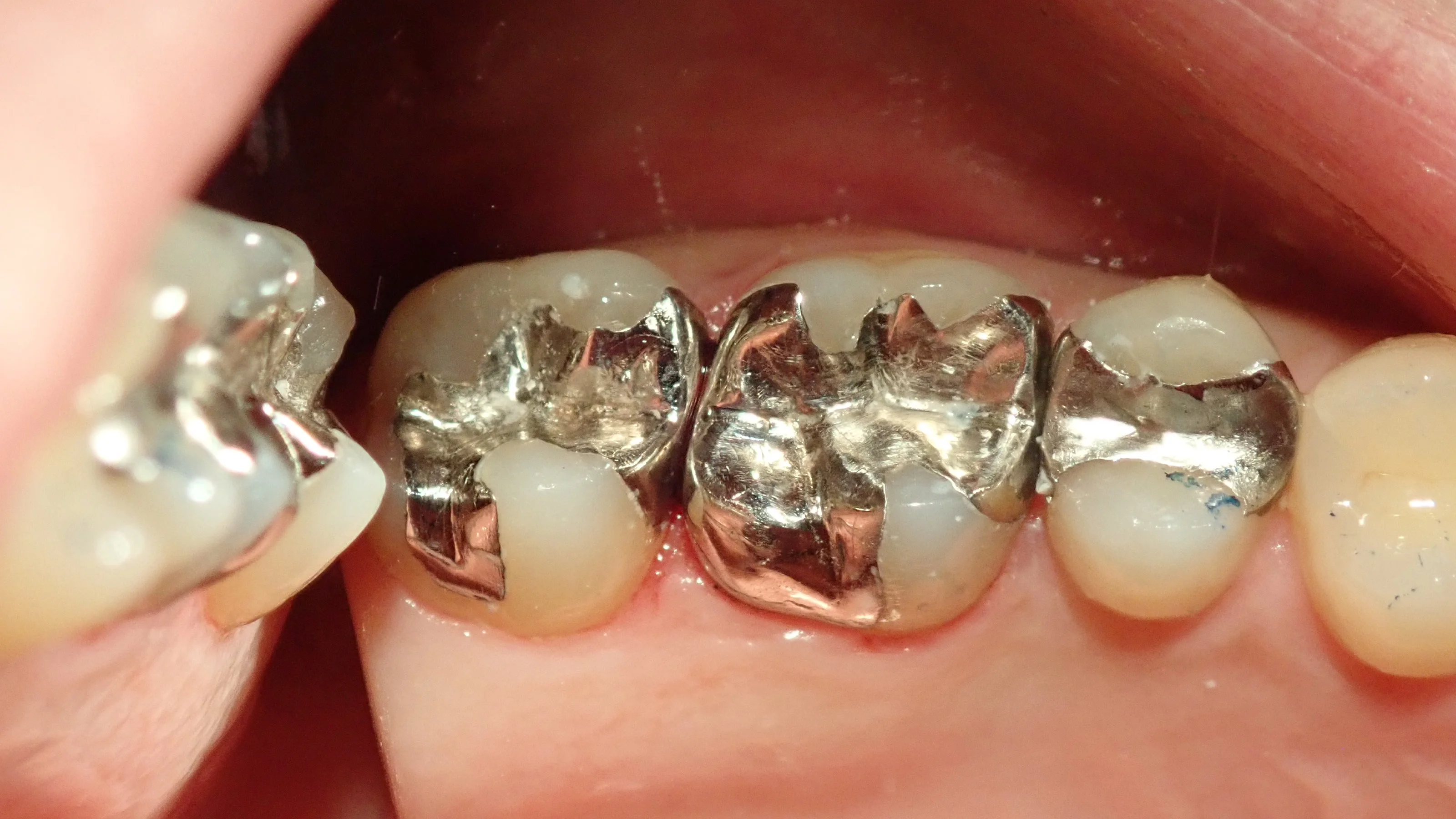 メタルインレー|坂寄歯科医院(取手市藤代) - 画像4