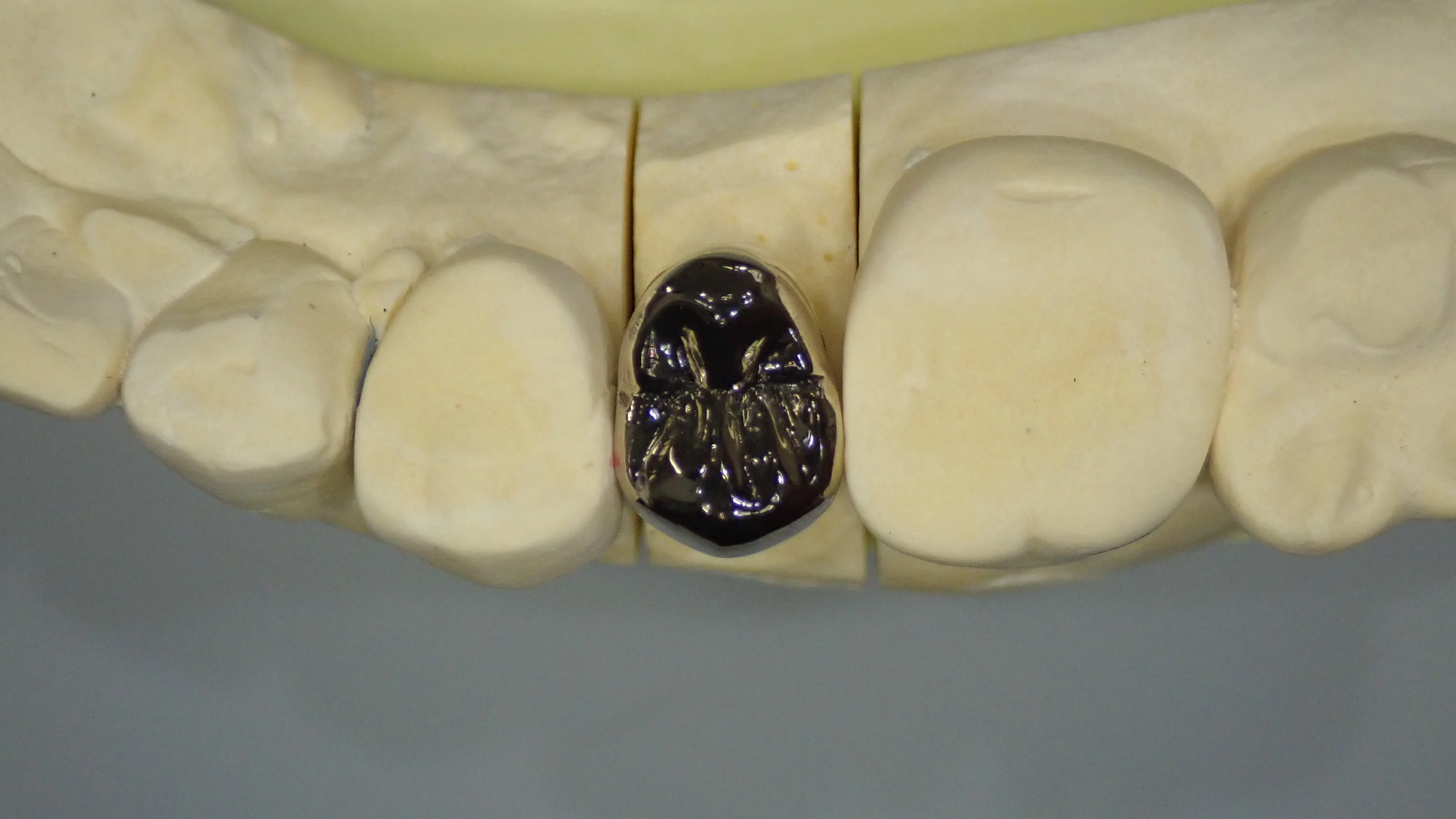 メタルクラウン|坂寄歯科医院(取手市藤代) - 画像6