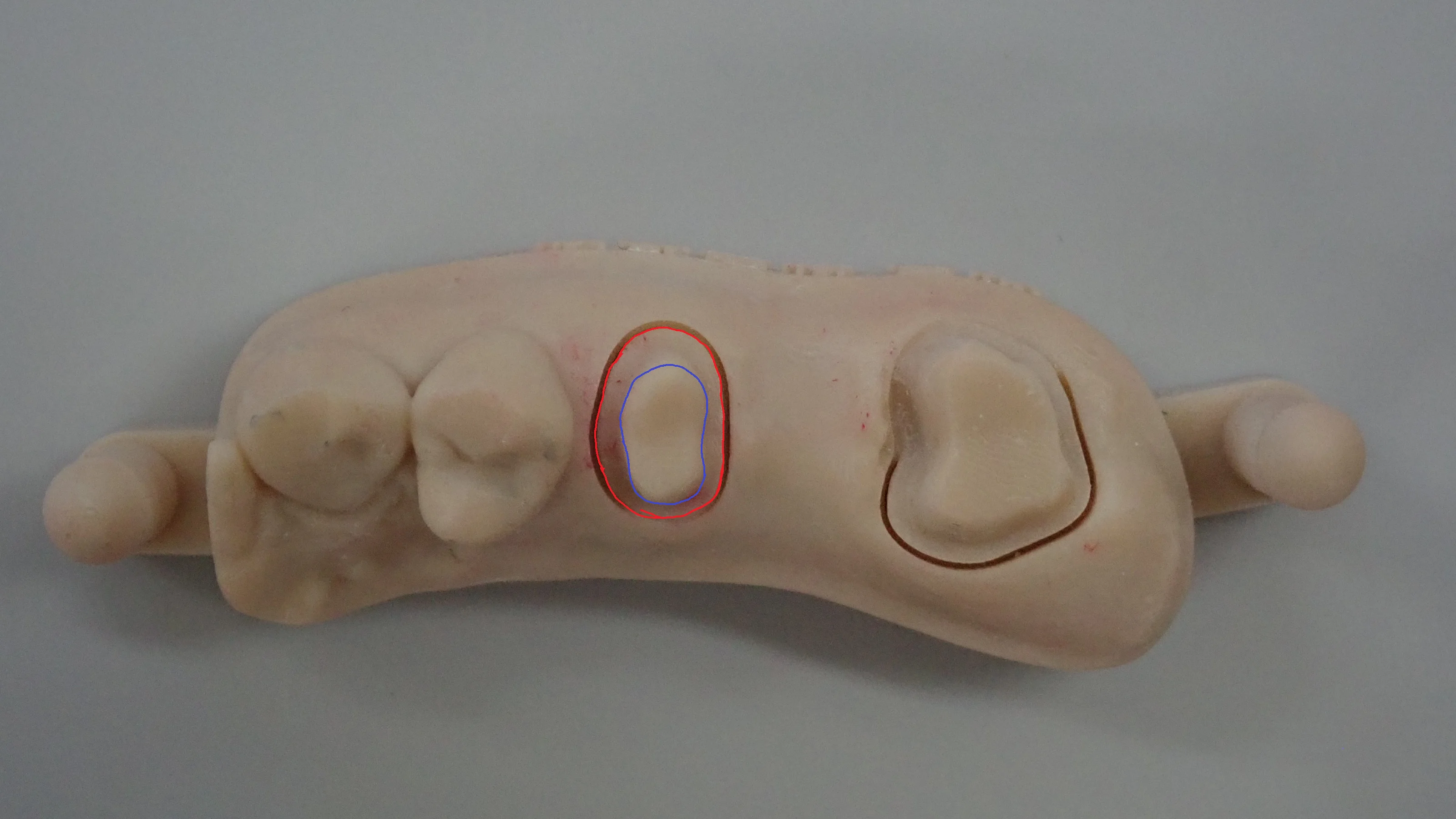 奥歯のセラミックブリッジ|坂寄歯科医院(取手市藤代) - 画像2