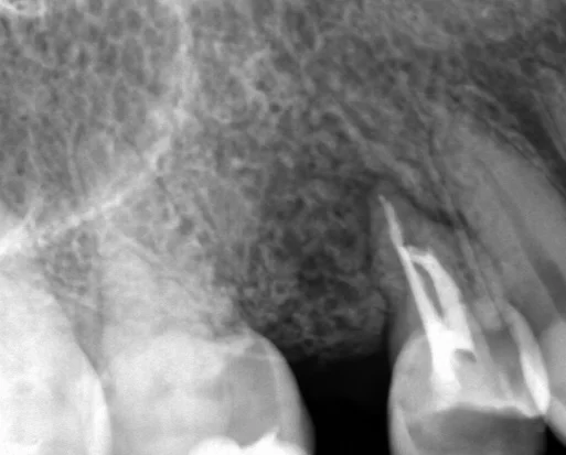 ダイレクトボンディング④｜坂寄歯科医院（取手市藤代） - 画像5