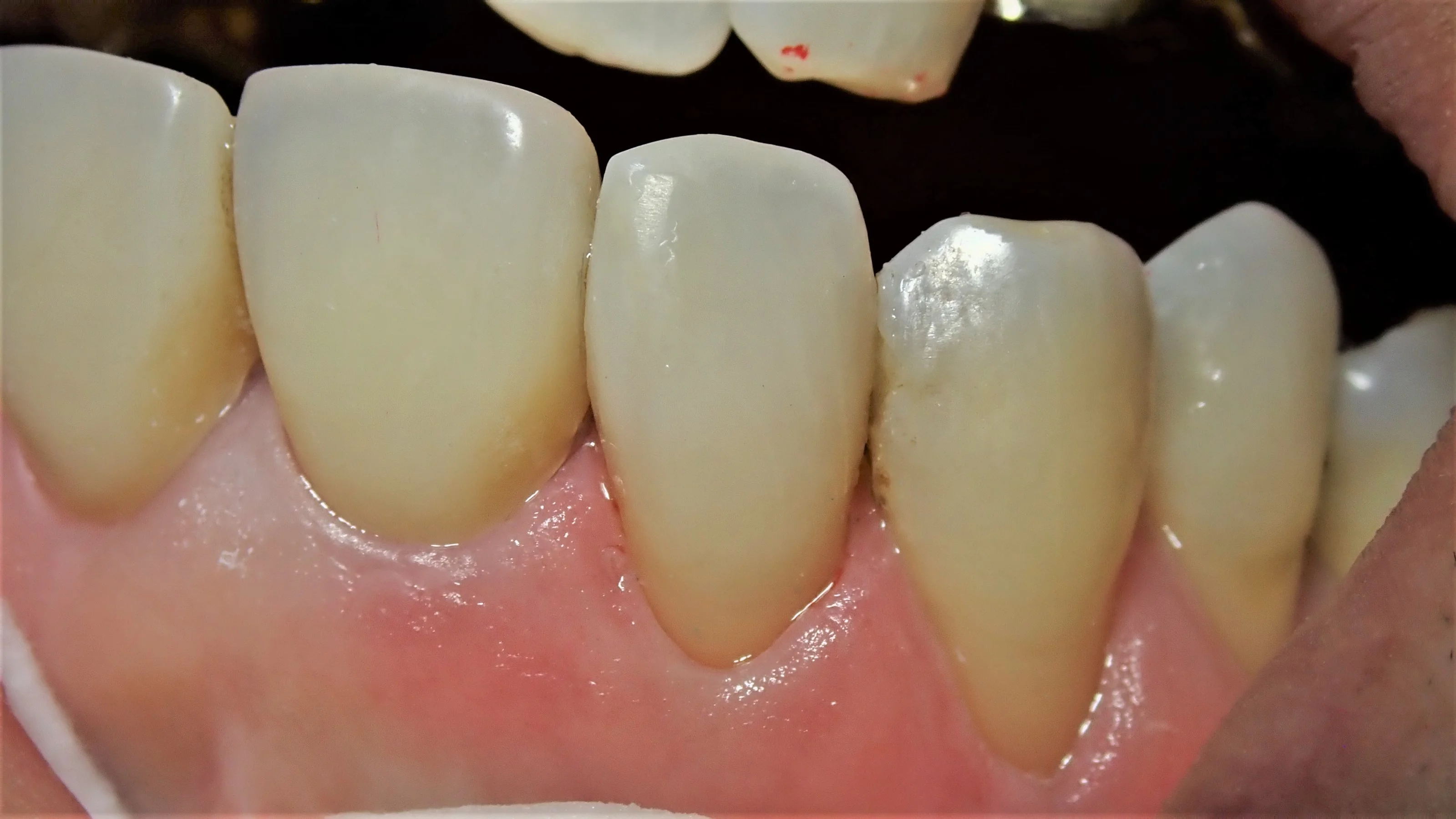 前歯ダイレクトボンディング｜坂寄歯科医院（取手市藤代） - 画像3